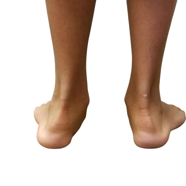 Düz Tabanlık Tedavisi – Pes Planus