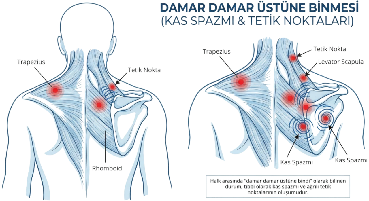 Damar Damar Üstüne Binmesi Nedir?