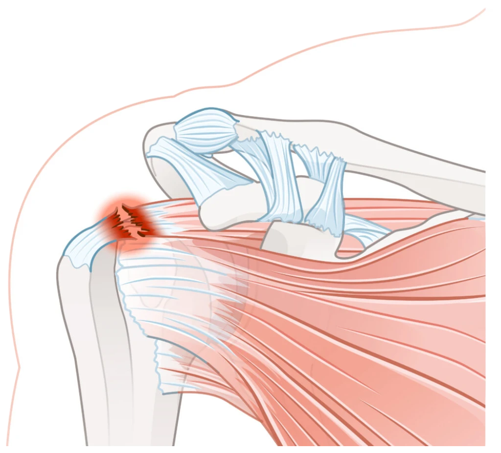 Rotator Cuff Yırtıkları: Belirtiler, Nedenleri ve Tedavi Yöntemleri